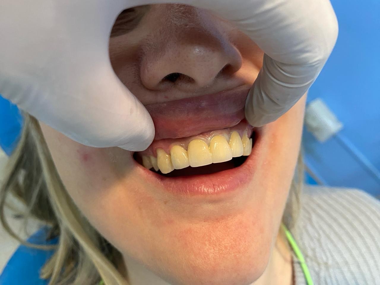 Corona de porcelana - Dentista Derqui Pilar